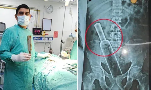 Đau bụng đi khám, bác sĩ sốc nặng khi chụp X-quang cho người đàn ông
